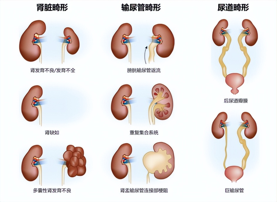 cakut按發生異常的部位不同,主要包括腎臟畸形,輸尿管畸形及尿道畸形