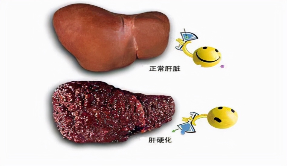 脾大治疗方法有哪些？脾大非肝硬化如何治疗效果最佳