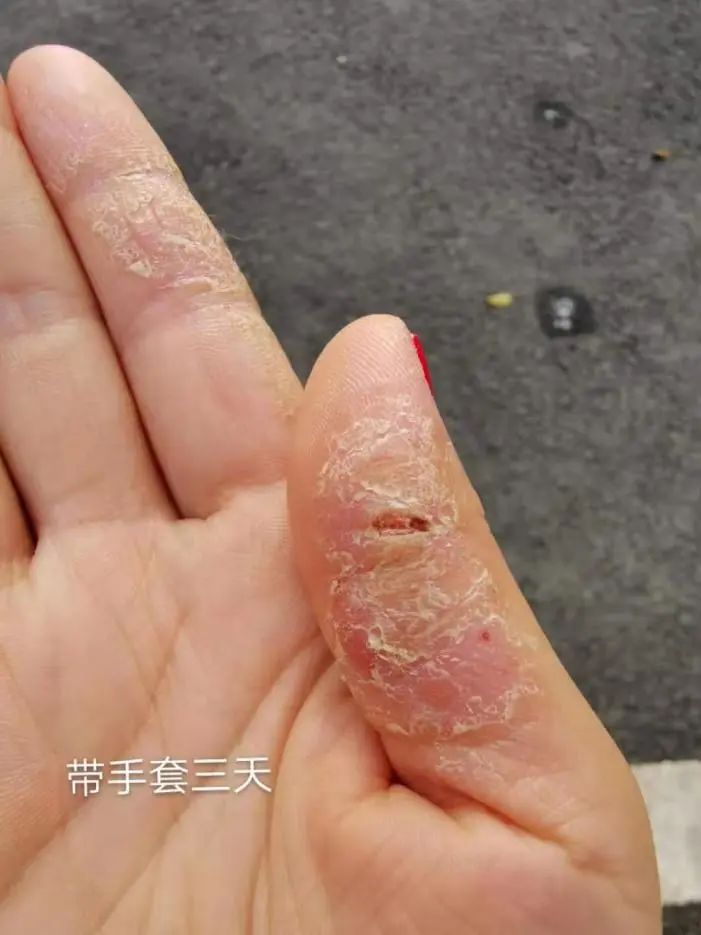 手上濕疹怎么治療（0用藥，只做這件事，就緩解多年頑固手濕疹！）