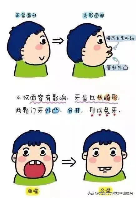 【儿童频道】宝宝睡觉打呼噜、口呼吸、越长越丑？可能是腺样体肥大惹的祸！