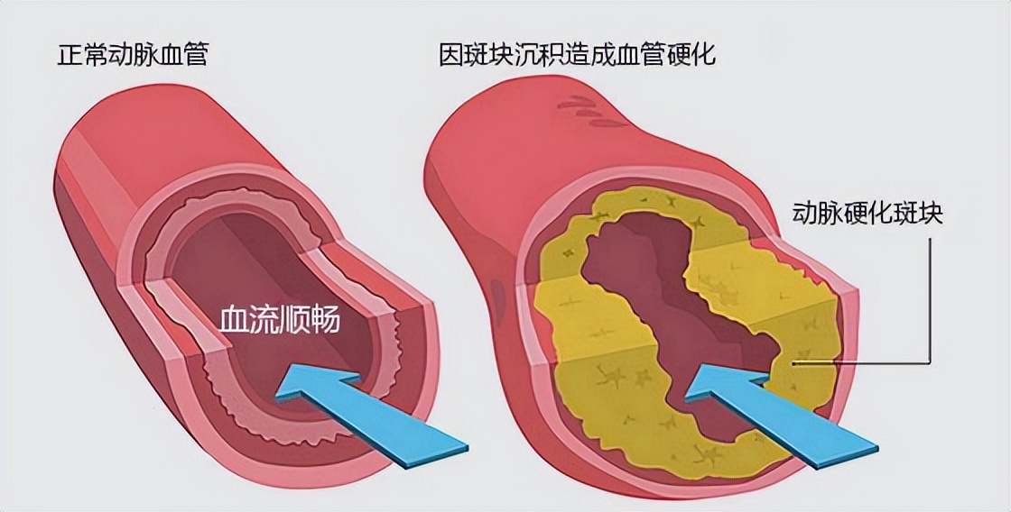 经常吃银杏叶片、银杏叶提取物片、血塞通、通心络，要注意什么？