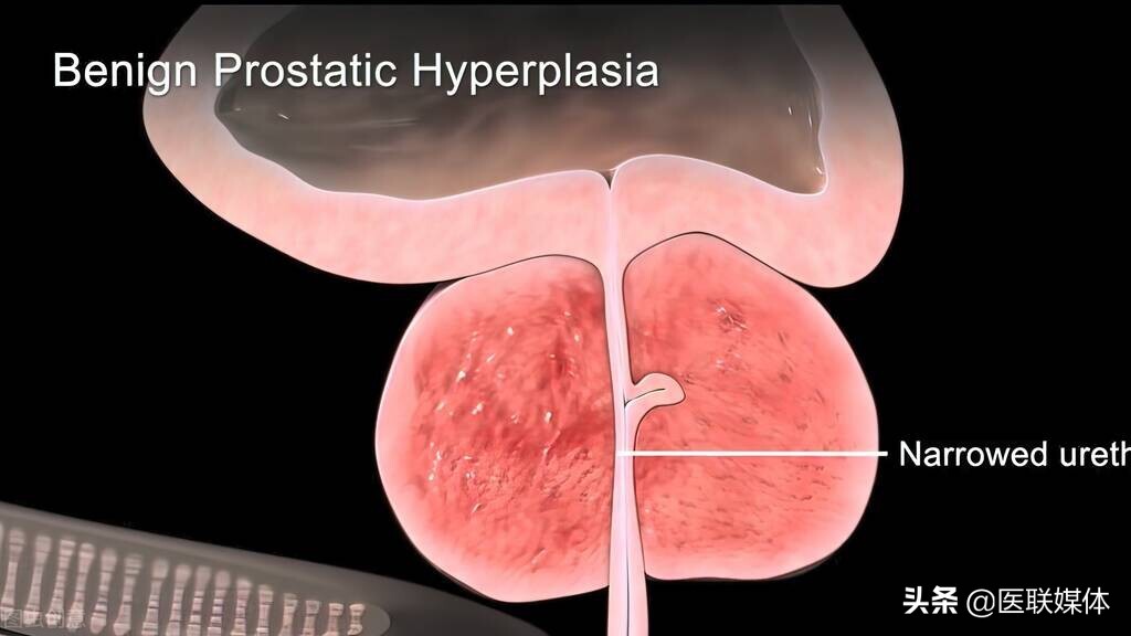 前列腺大就是前列腺增生？ 6大常見誤區，男性別踩坑