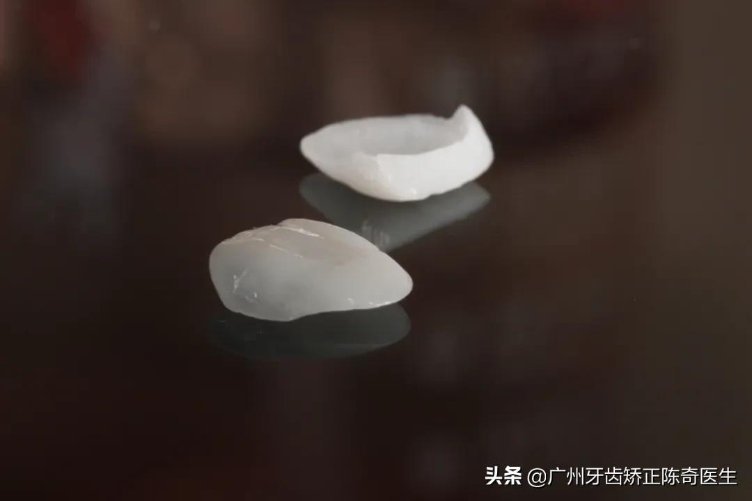 牙黄、牙缝大、牙齿缺损?明星们都在做的牙齿贴面了解一下