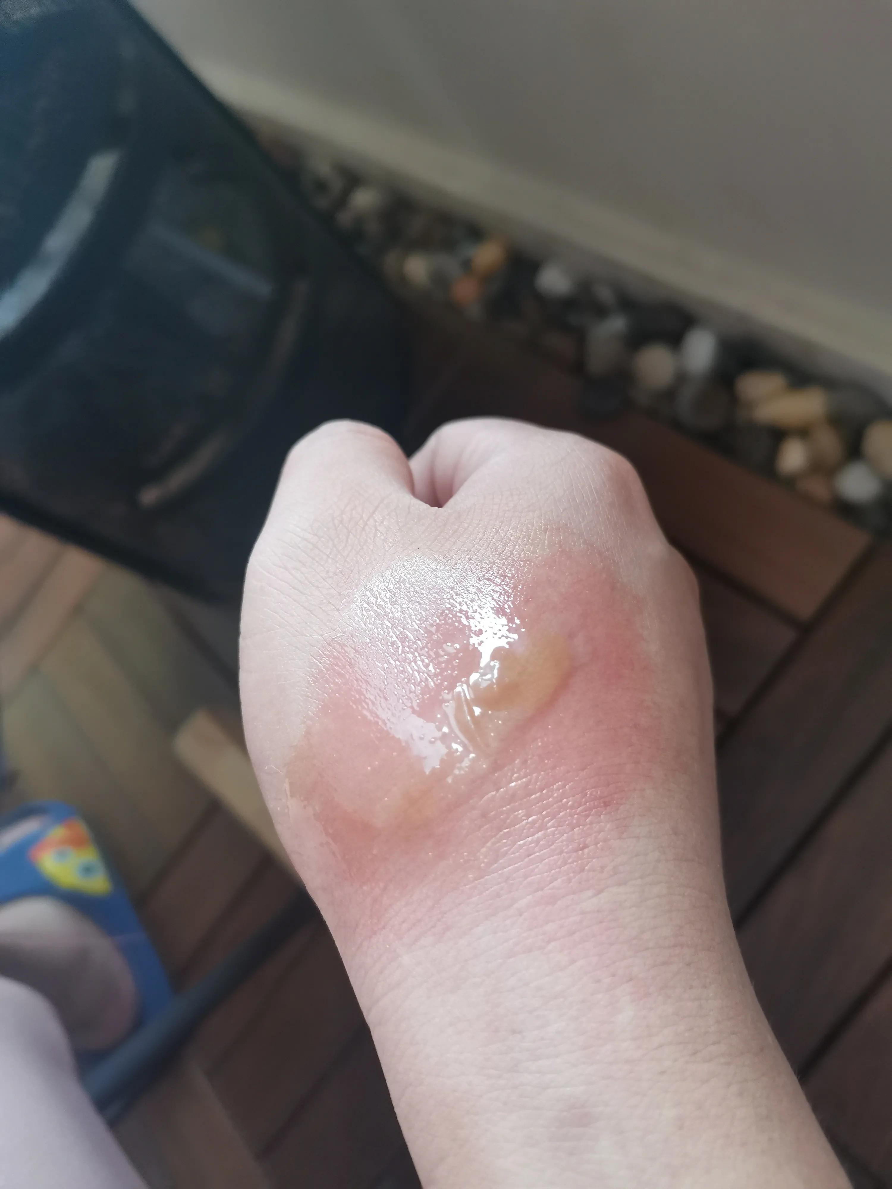 烫伤多久可以恢复正常肤色「二度烫伤多久可以恢复」