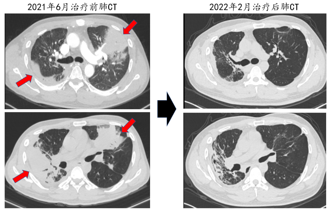 4年反复住院12次、250余天！广西一男子确诊此罕见病，为全国首例成人发病