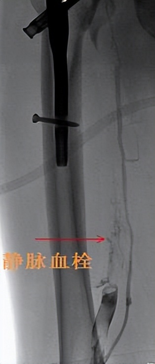 不打烊 更方便 周围血管科（介入科）开设周六全天门诊