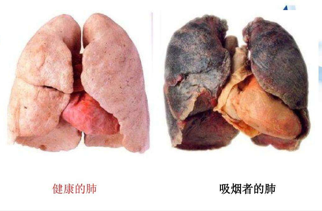 吸烟者的肺图片 吸烟10年的肺彩超图片