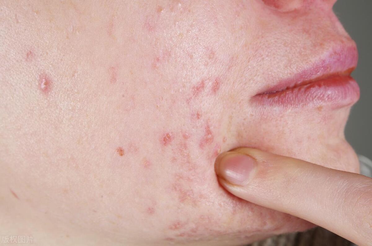 过敏症(「科普」6种常见的皮肤病,教你区分它们的症状和发病原因)