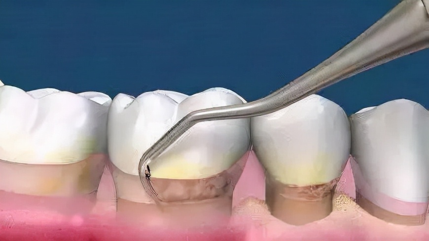 人到中年牙齿松动、不牢固？医生：这些方法挽留牙齿很实用