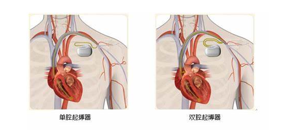 临起搏器安装部位图解图片