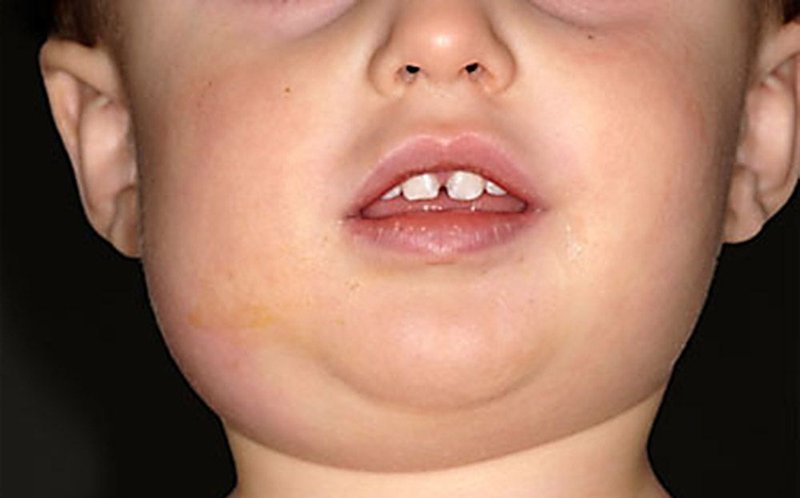 儿童急性腮腺炎图片