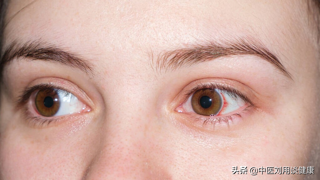 眼白浑浊发黄有血丝怎么回事儿(眼白浑浊发黄有血丝怎么改善)-友友