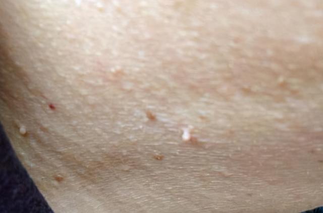 腋下长了一个小疙瘩是什么东西 腋窝长了一个包图片-文化号