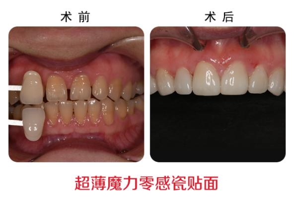 两个牙之间有缝儿怎么办（牙齿有缝怎么弄）-第1张图片