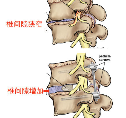 腰椎疾病要不要做手术?到底应该听谁的?医生告诉你