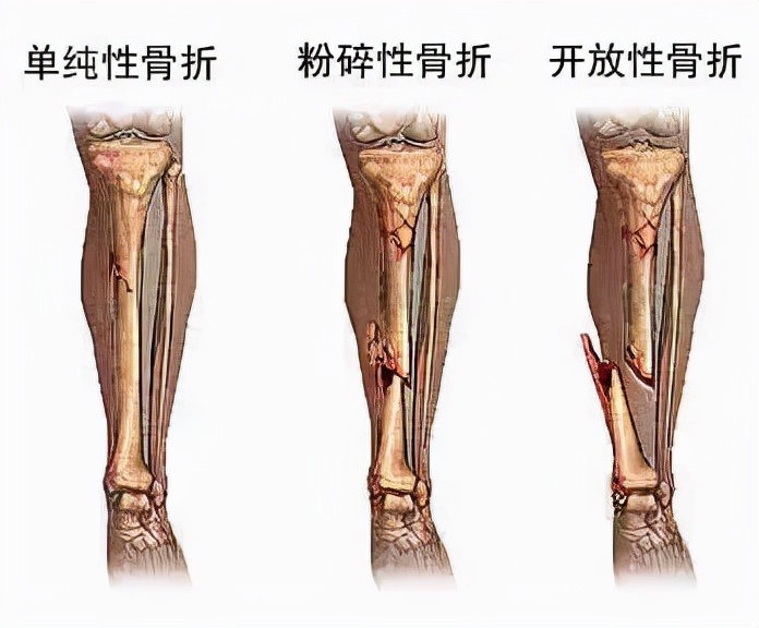 为何有些骨折疼痛难忍，却不能立即做手术？听听医生怎么解释