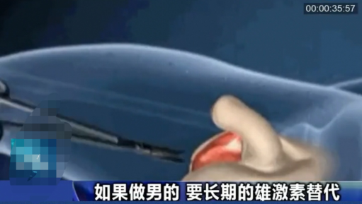 小伙网上自学自宫手术切除睾丸,扔马桶里冲掉,直言不想再做男人