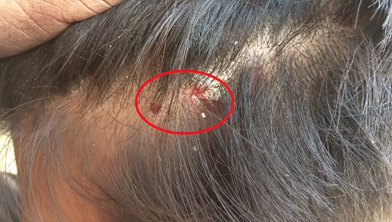 婴儿头上小白泡是什么(头皮上经常长脓包和疙瘩) - 乐宝宝贝