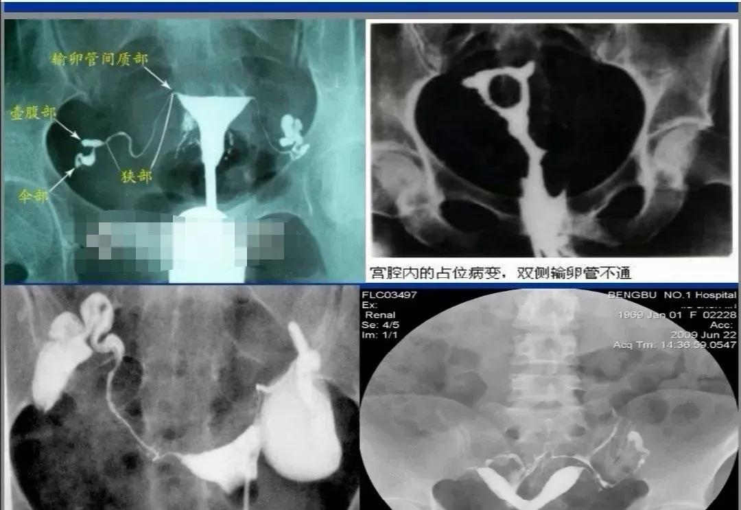 输卵管造影大概费用（输卵管检查需要多少钱？输卵管检查方法有哪些？）