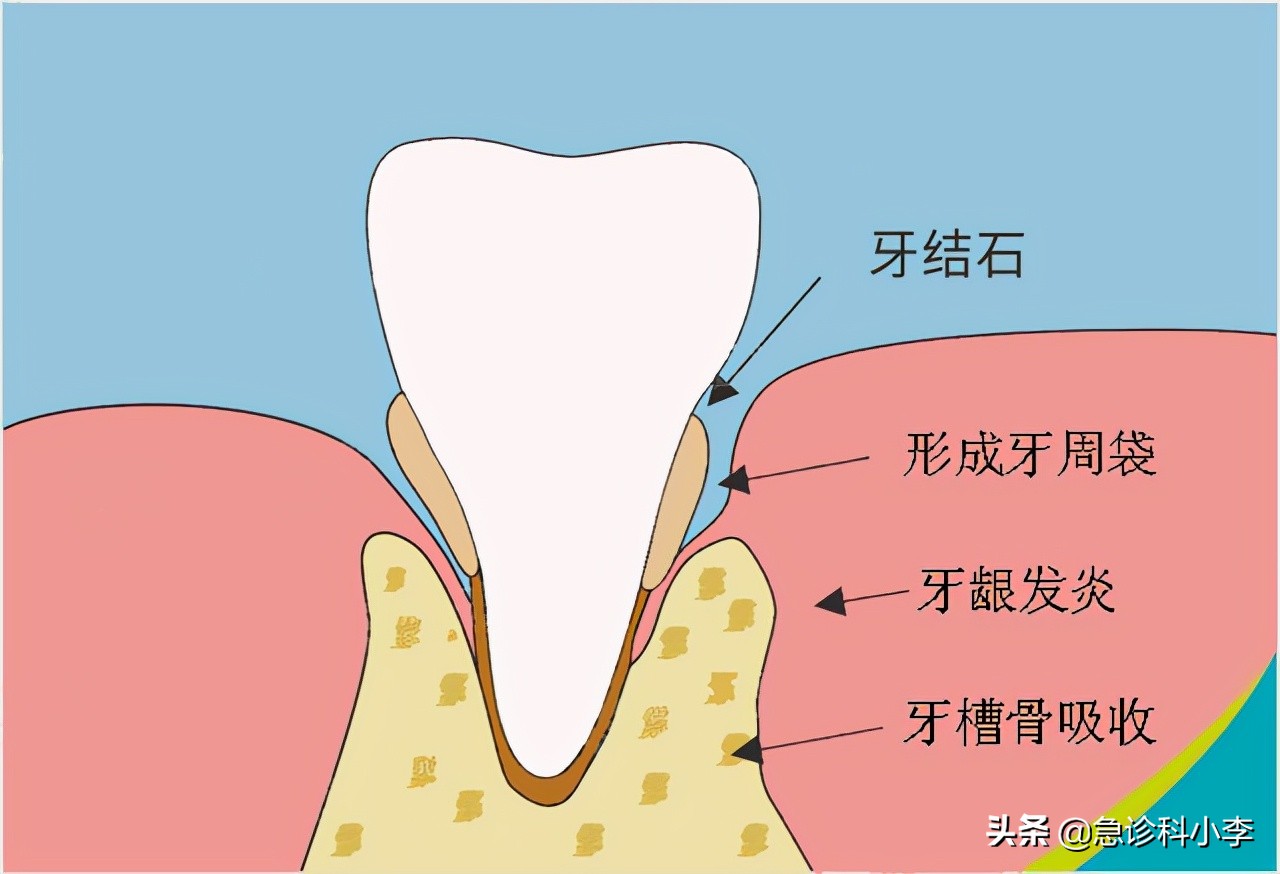 牙缝里的牙结石，如何清除干净？3个办法是不少人的选择