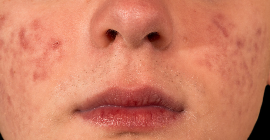 嘴角裂口是什么原因（烂嘴角都是因为上火吗？为你揭秘烂嘴角的背后的7大原因）