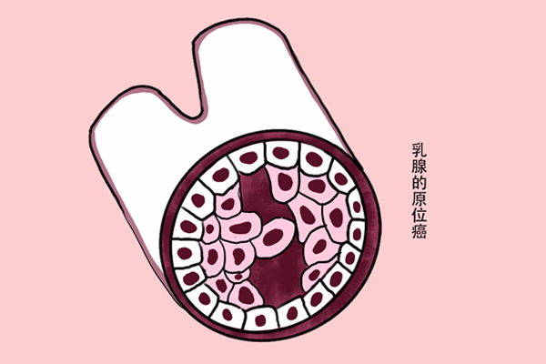 备受争议的3种“癌”不致命，不建议过度治疗，假如你有，别紧张