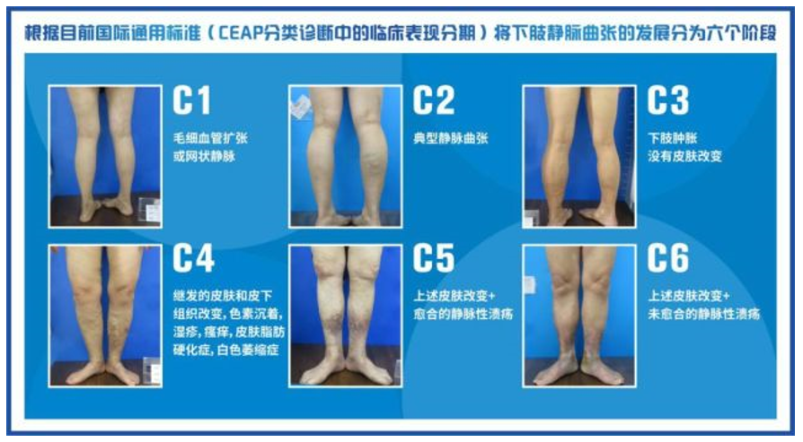 国产首款！惠及一亿人的“血管万能胶”进入临床