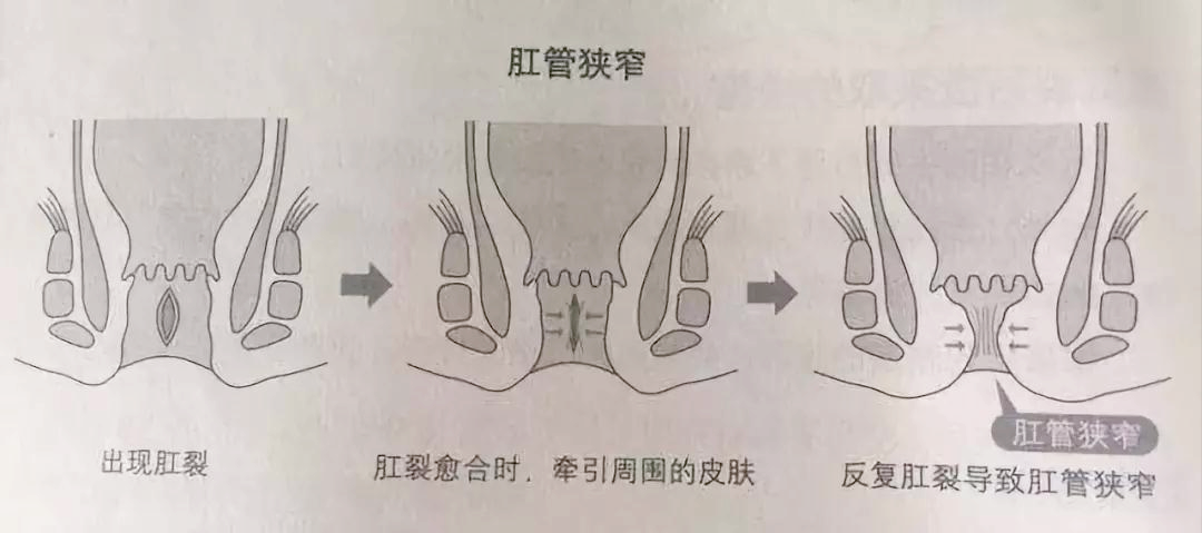 医生亲身和肛裂斗争的那些事