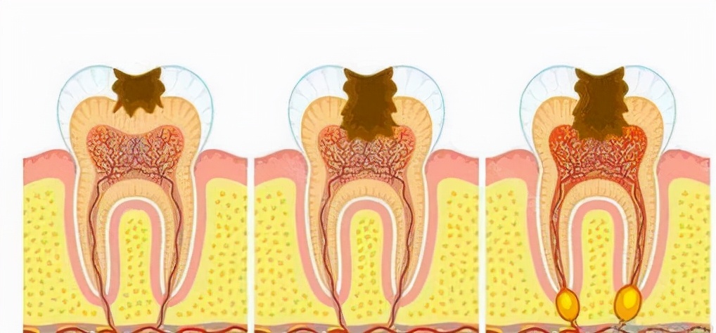 「牙齿那些事儿」No.79丨什么是根管治疗？根管后的牙齿能用多久