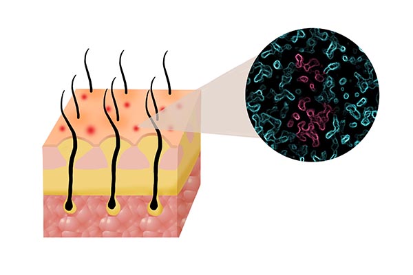 毛囊炎疙瘩怎么消除（头皮总是长疙瘩、脓包，怎么回事？能抠掉吗？一文告知）