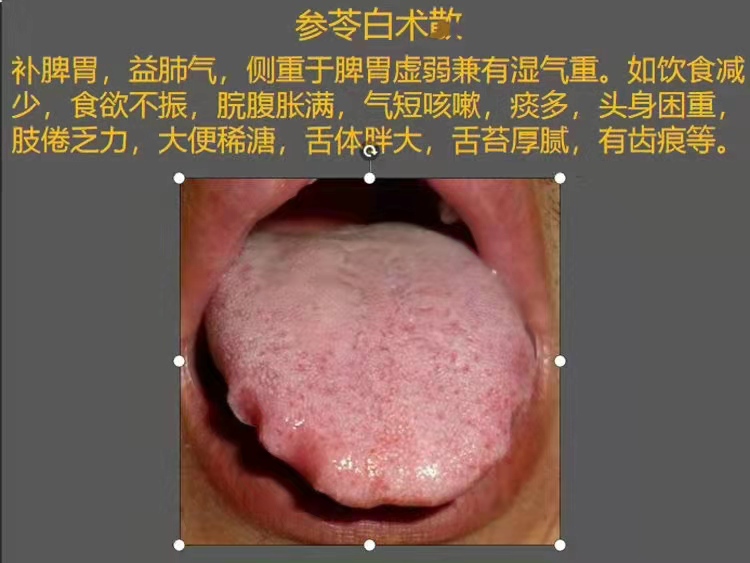 齿痕舌是什么原因造成的？舌头出现齿痕的健康信号