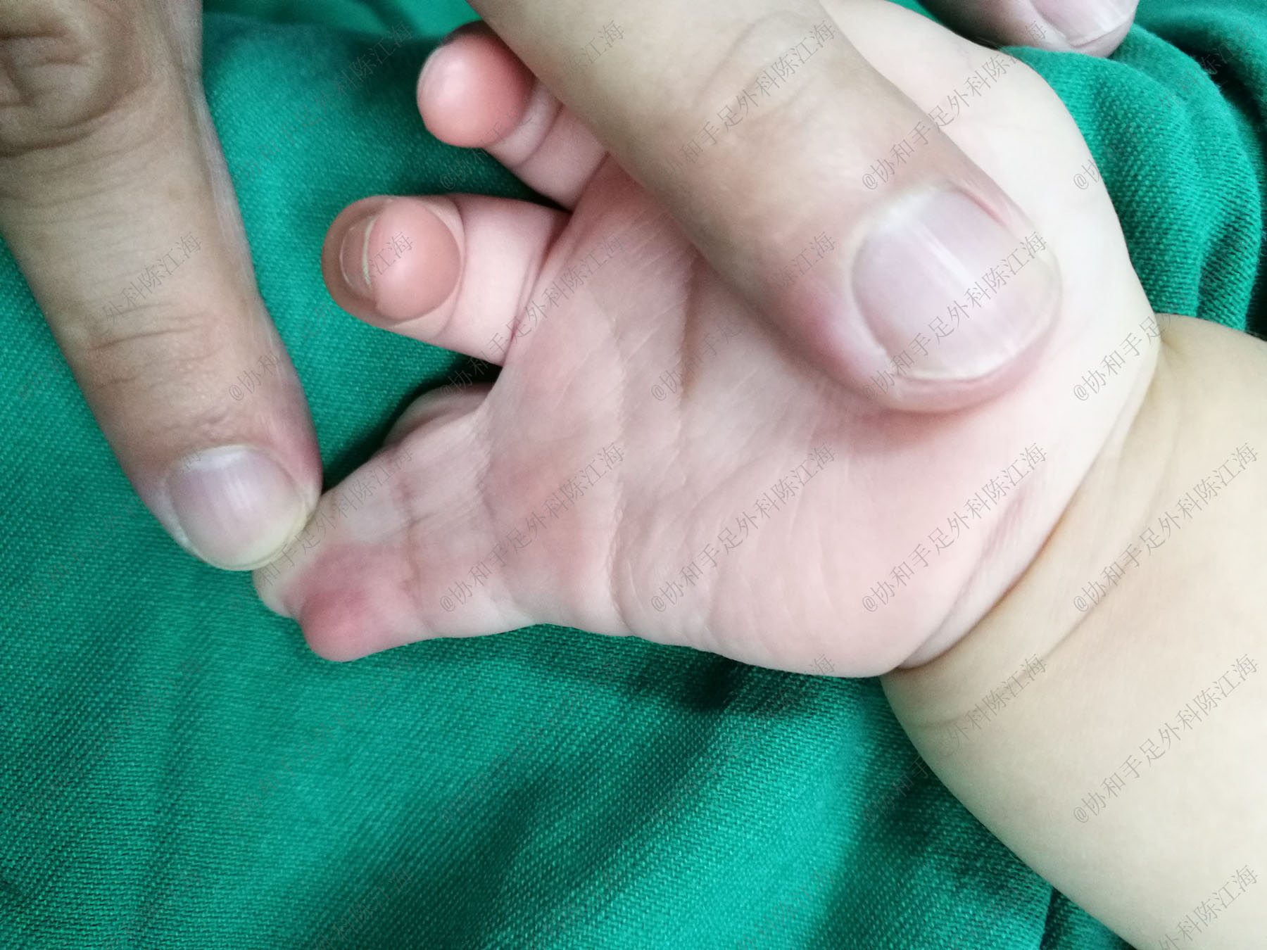 宝宝并指手术需植皮，妈妈哭求用自己的，医生：现在有免植皮技术-春雨医生