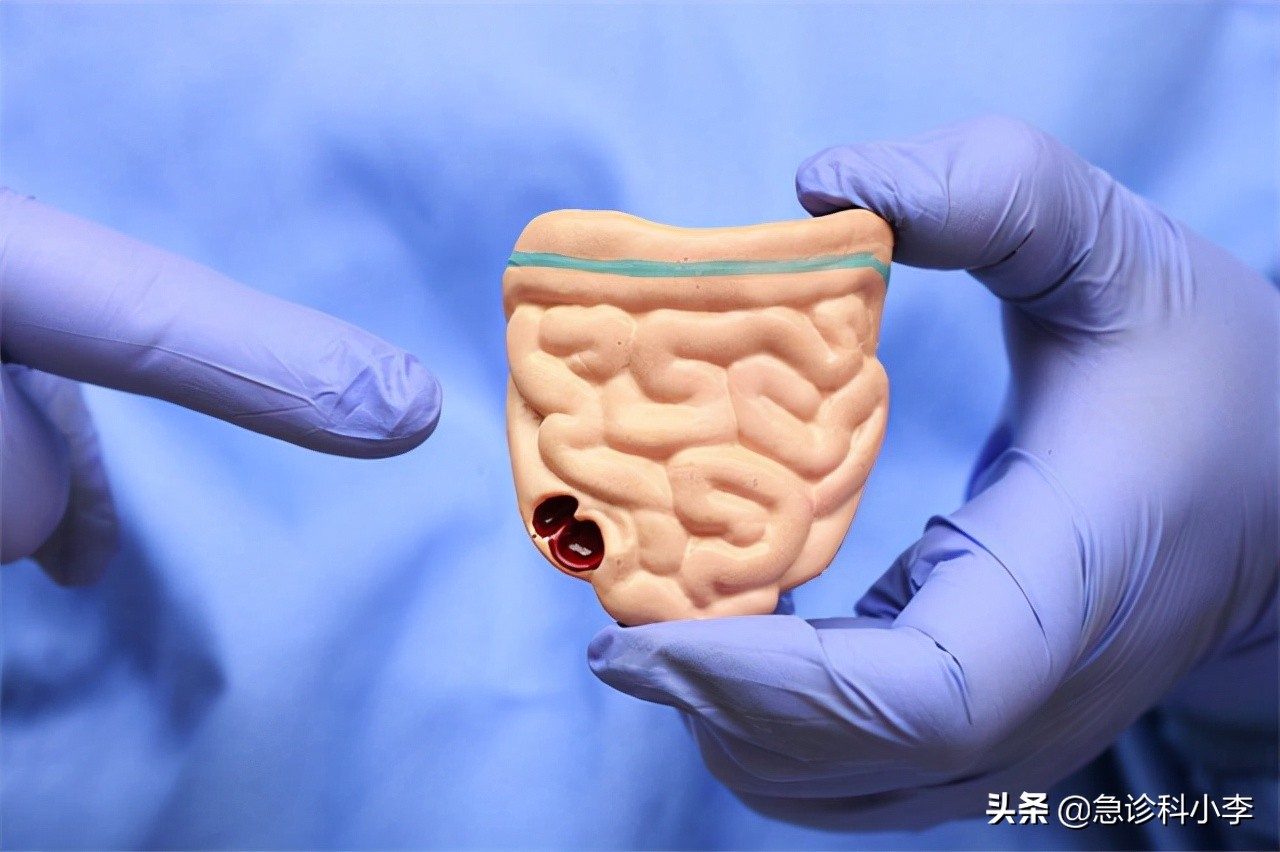 30岁小伙每天大便两三次，确诊肠癌！3种大便异常是身体“警报”