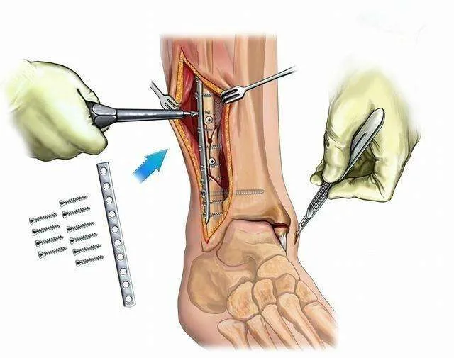 骨折愈合后钢板要不要取出？来看看医生怎么说