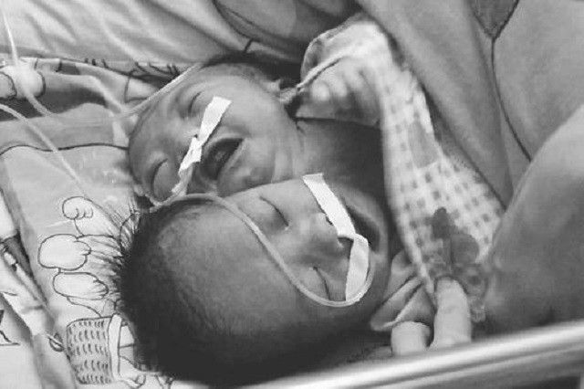 2011年四川产妇诞下中国首例“双头女婴”，后将产检医院告上公堂