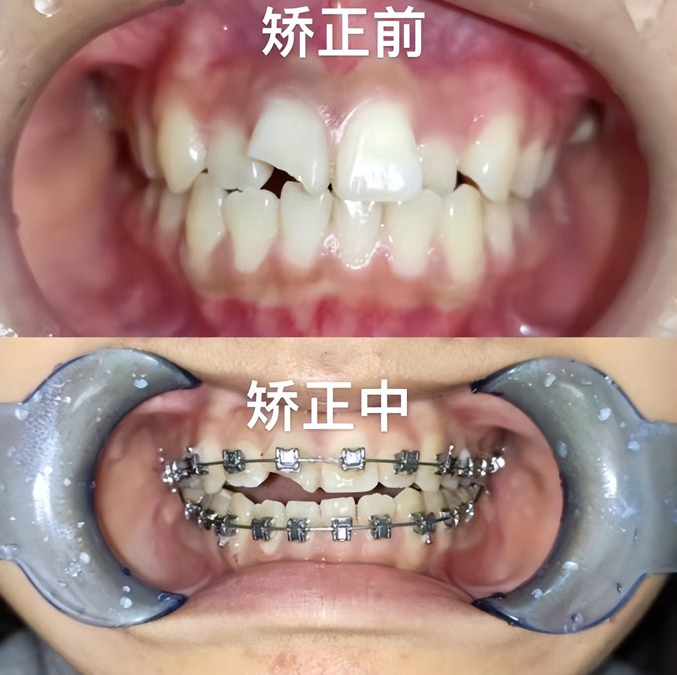 武汉13岁女孩不小心磕掉半边门牙，修复矫正后绽放自信歌喉