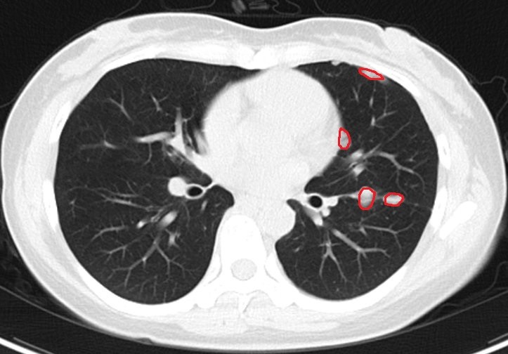 晚期肺癌的长期生存在坚持与关爱中实现