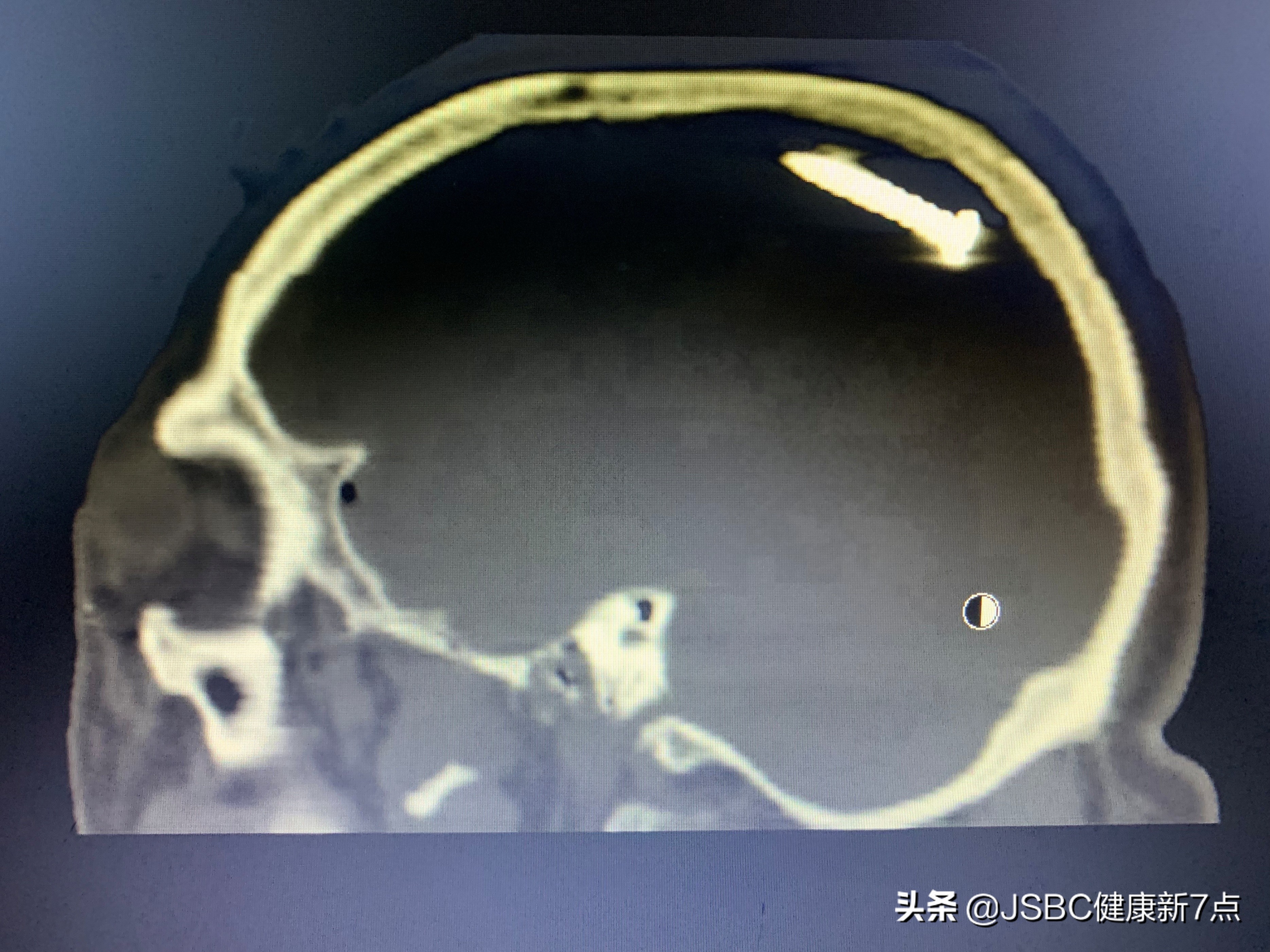 天气炎热头部外伤频发 施工现场不带安全帽 水泥钉飞进脑门