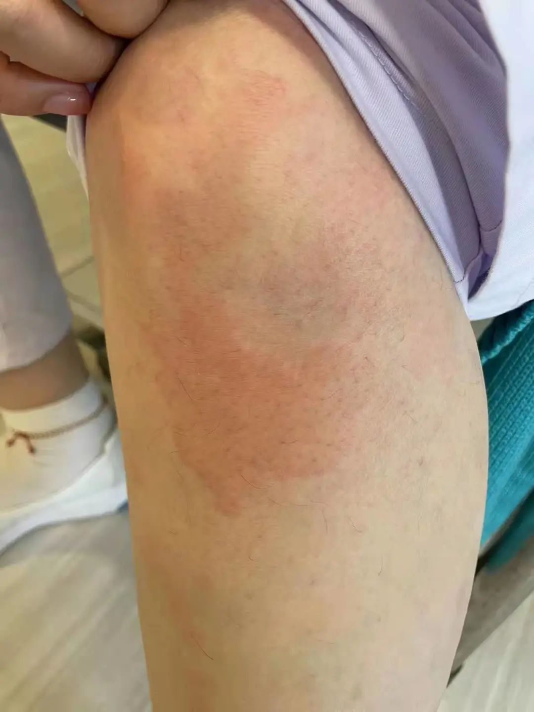 孩子荨麻疹反复发作,治疗其实很简单