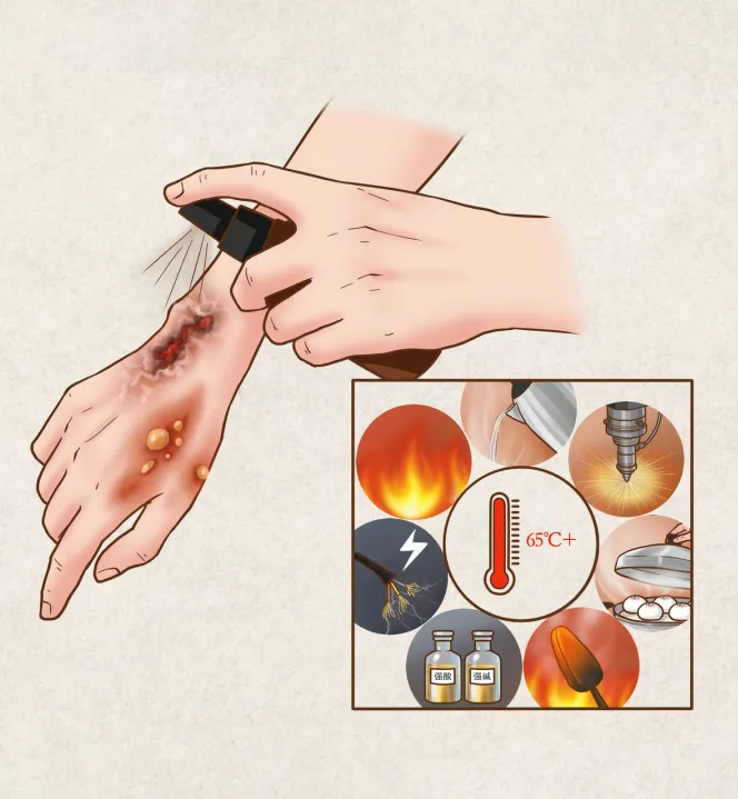 烧烫伤!如何紧急自救?