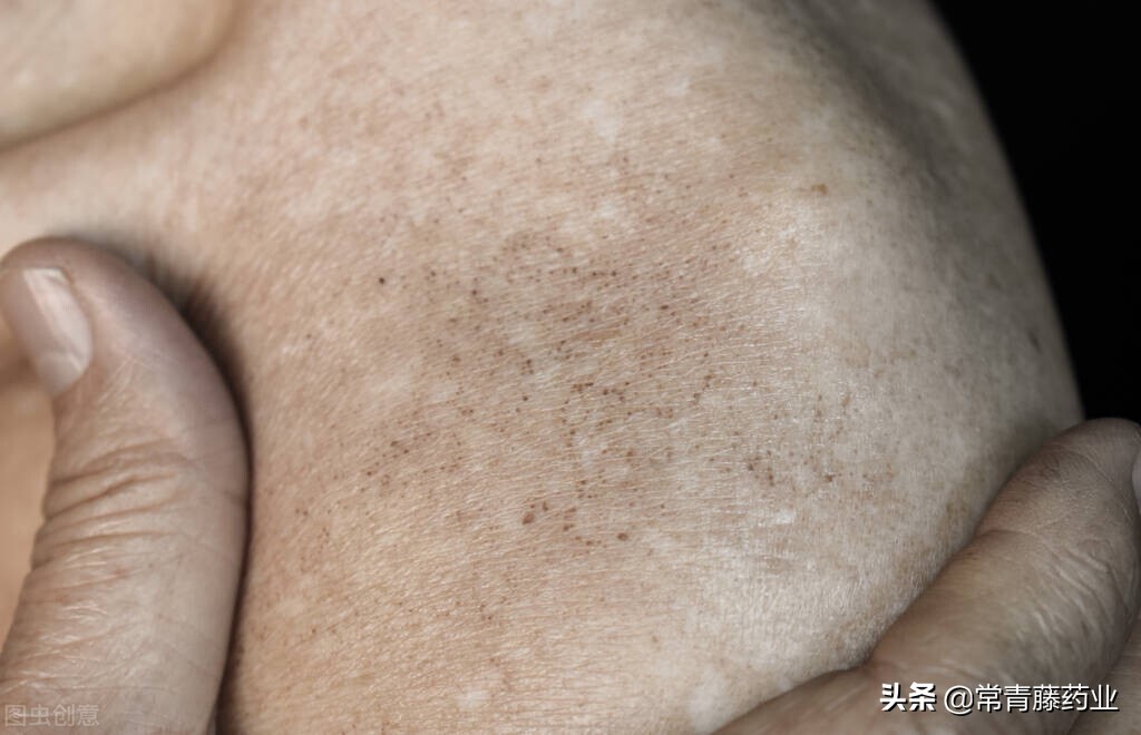 晒斑,雀斑,黄褐斑等,一文说6种色斑
