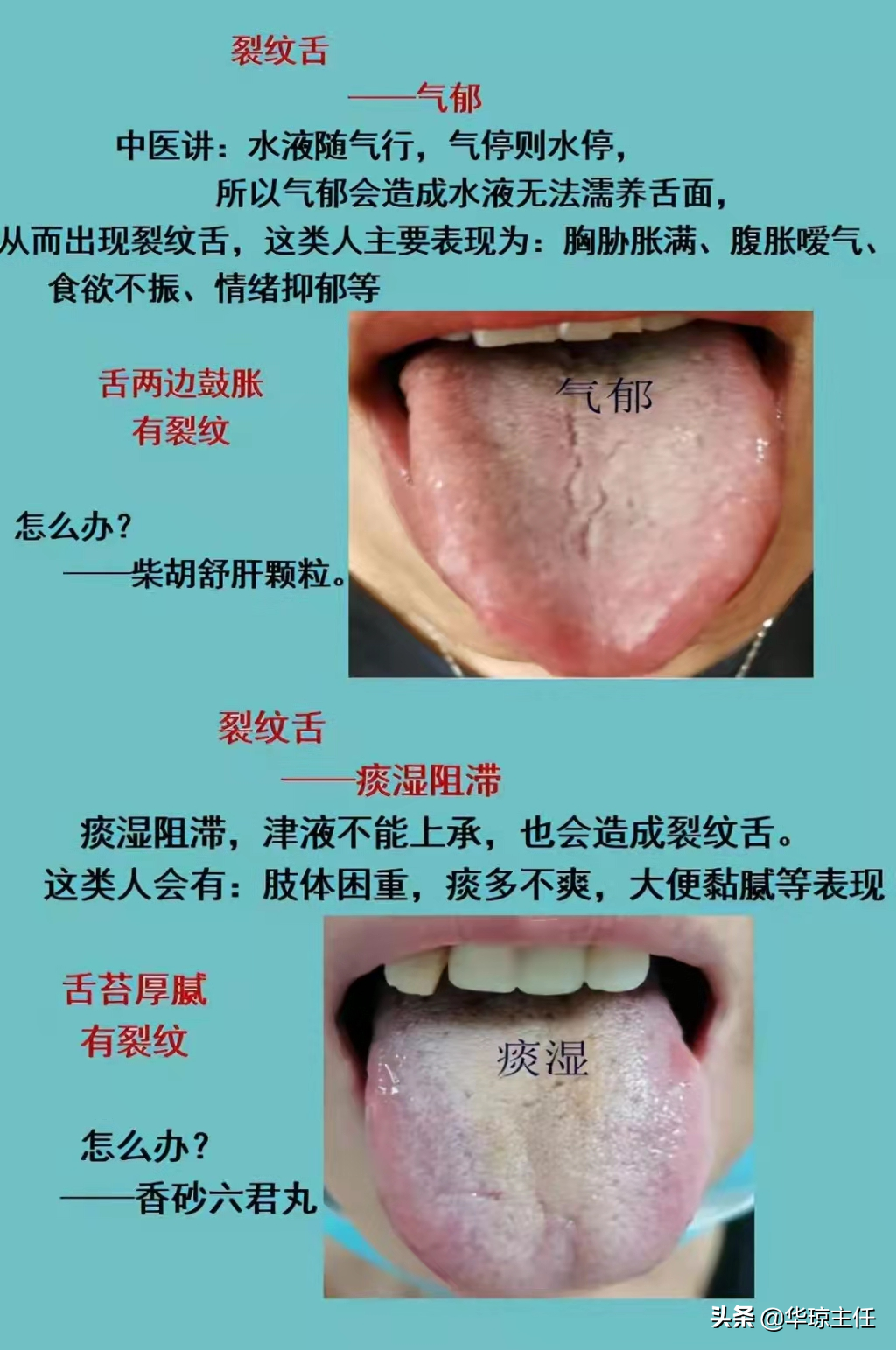 舌有裂纹就是阴虚？四种裂纹舌，十种舌象看看你是属于哪一种？