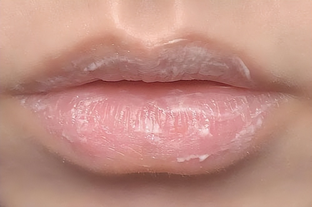 嘴唇干燥起皮是什么原因?撕嘴皮有什么危害?干燥起皮吃什么好?