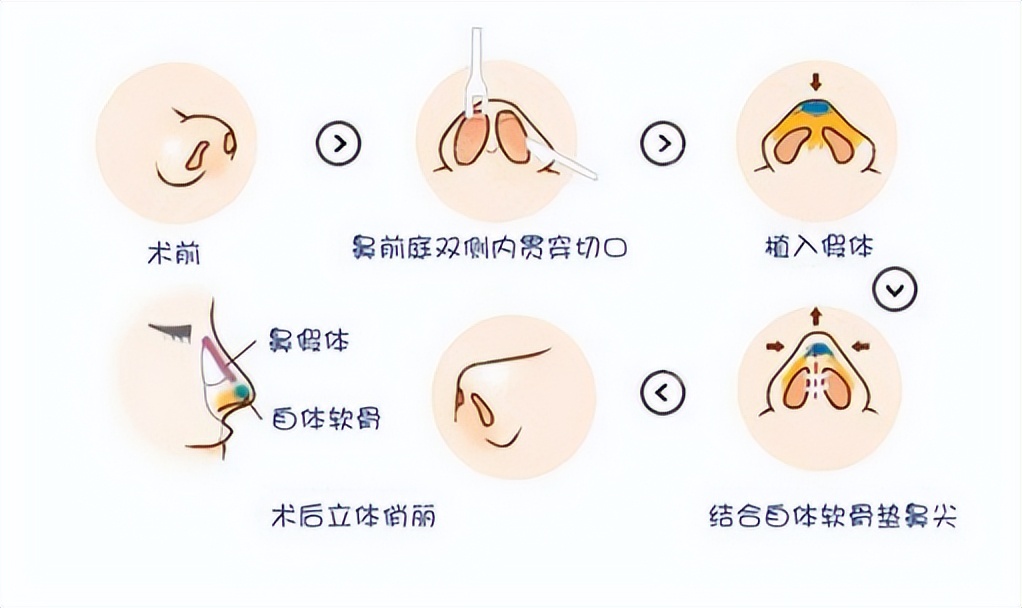 鹰钩鼻矫正后也太香了，从线条硬朗立马变成女人味十足