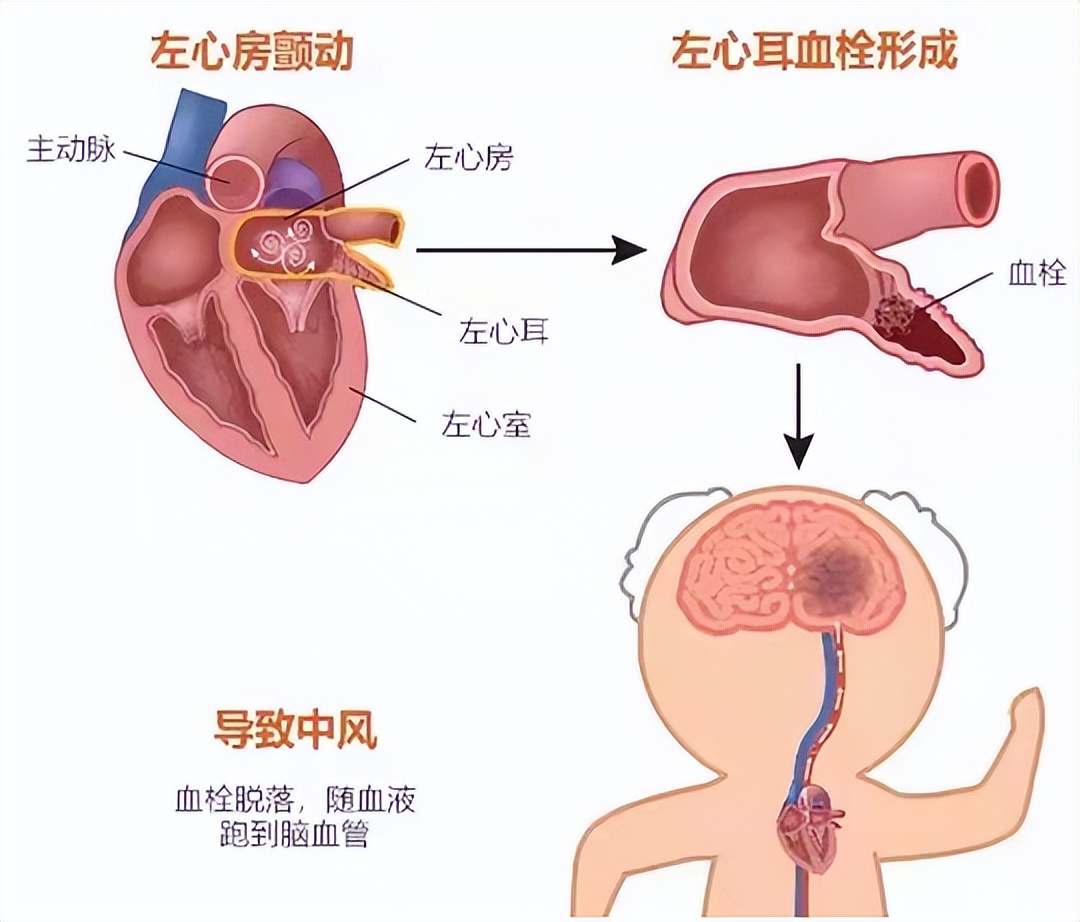 葛均波院士，一天完成三創(chuàng)新醫(yī)械產(chǎn)品首次手術(shù)