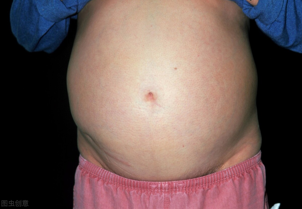 肝病患者为什么会出现腹水？有三个因素，中西医治疗有哪些不同？