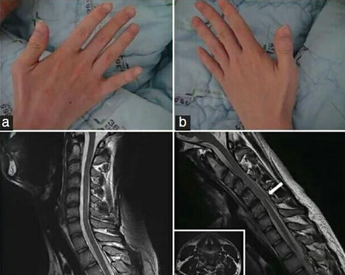 手部无力,上肢萎缩,手掌呈爪状?医生提醒:警惕"平山病"
