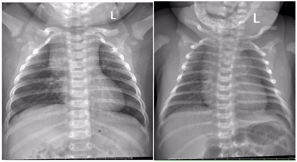 这几组患儿胸片,是肺炎?还是正常影像?规培医师懵了