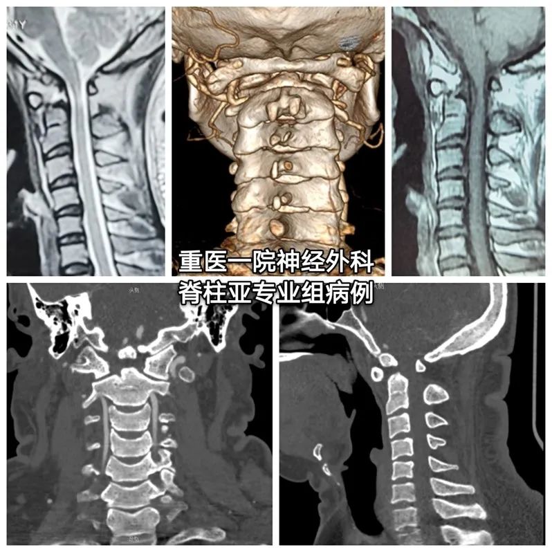 C2椎动脉高跨置钉技术之N