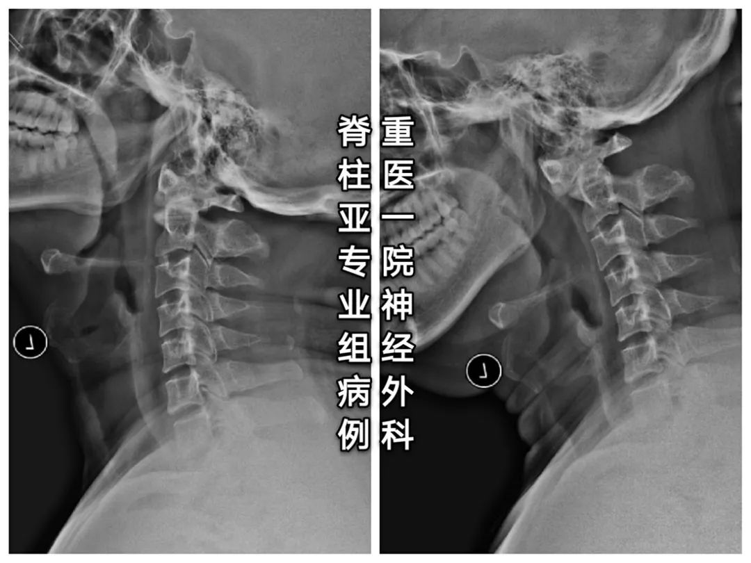 C2椎动脉高跨置钉技术之N